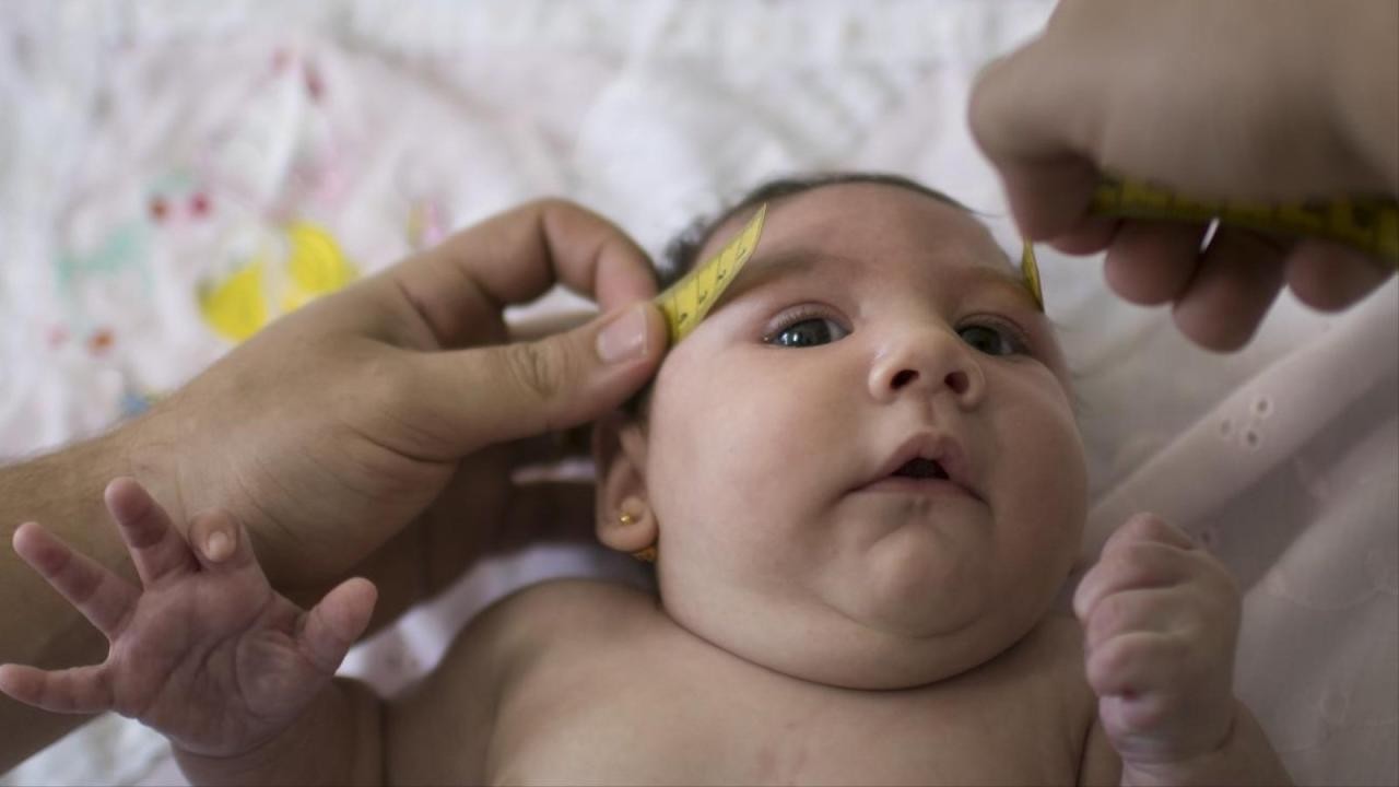 زيكا قد يسبب صغر الرأس لرضع طبيعيين في سنتهم الأولى