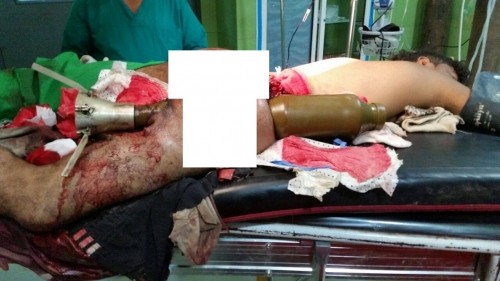 "بالصور" صاروخ حوثي مغروس في جسد جندي من الجيش الوطني وما زال على قيد الحياة